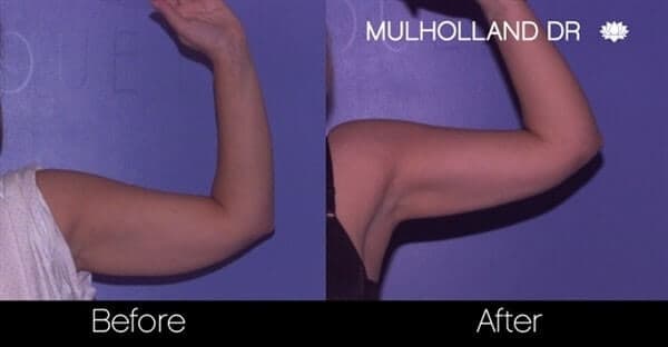 Arm Lift - Before and After Gallery – Photo 16