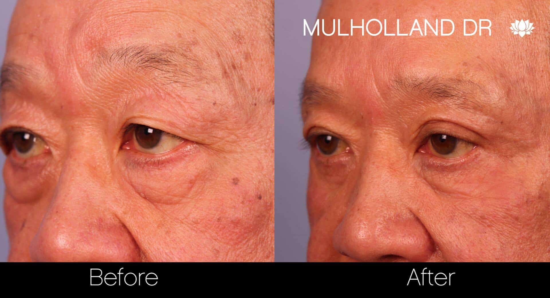 Blepharoplasty - Before and After Gallery – Photo 16