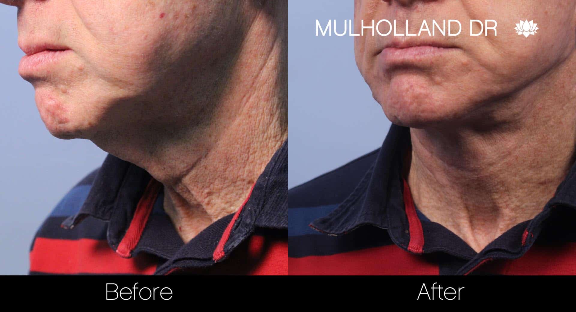Male Double Chin - Before and After Gallery – Photo 16
