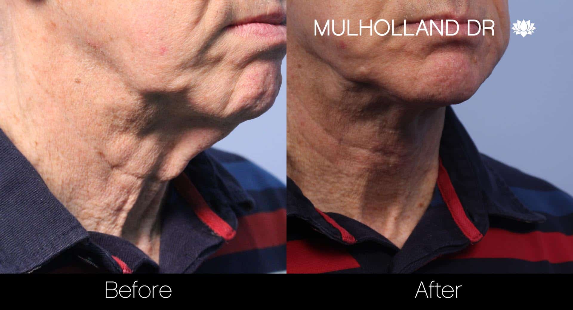 Male Double Chin - Before and After Gallery – Photo 18