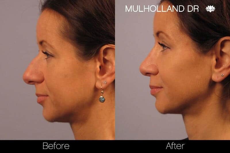 Rhinoplasty - Before and After Gallery - Patient Photo 19