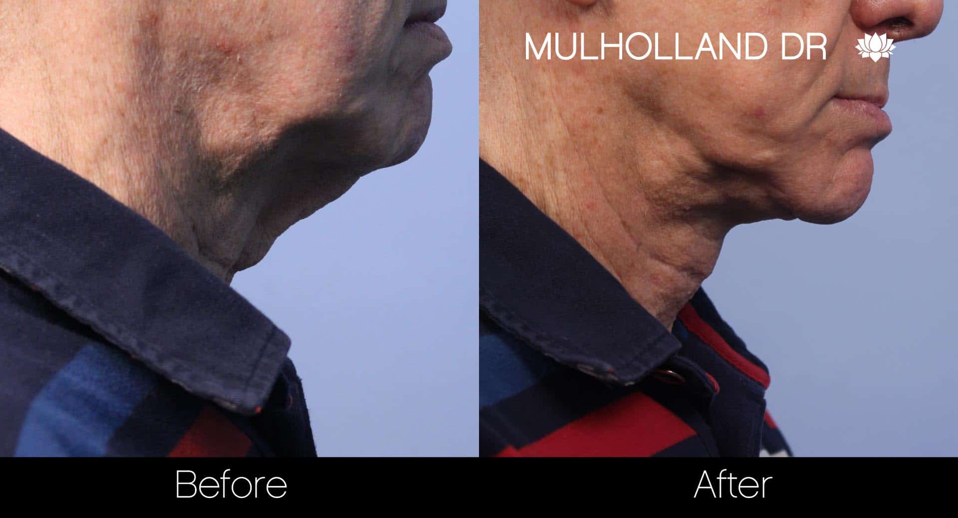 Male Double Chin - Before and After Gallery – Photo 19