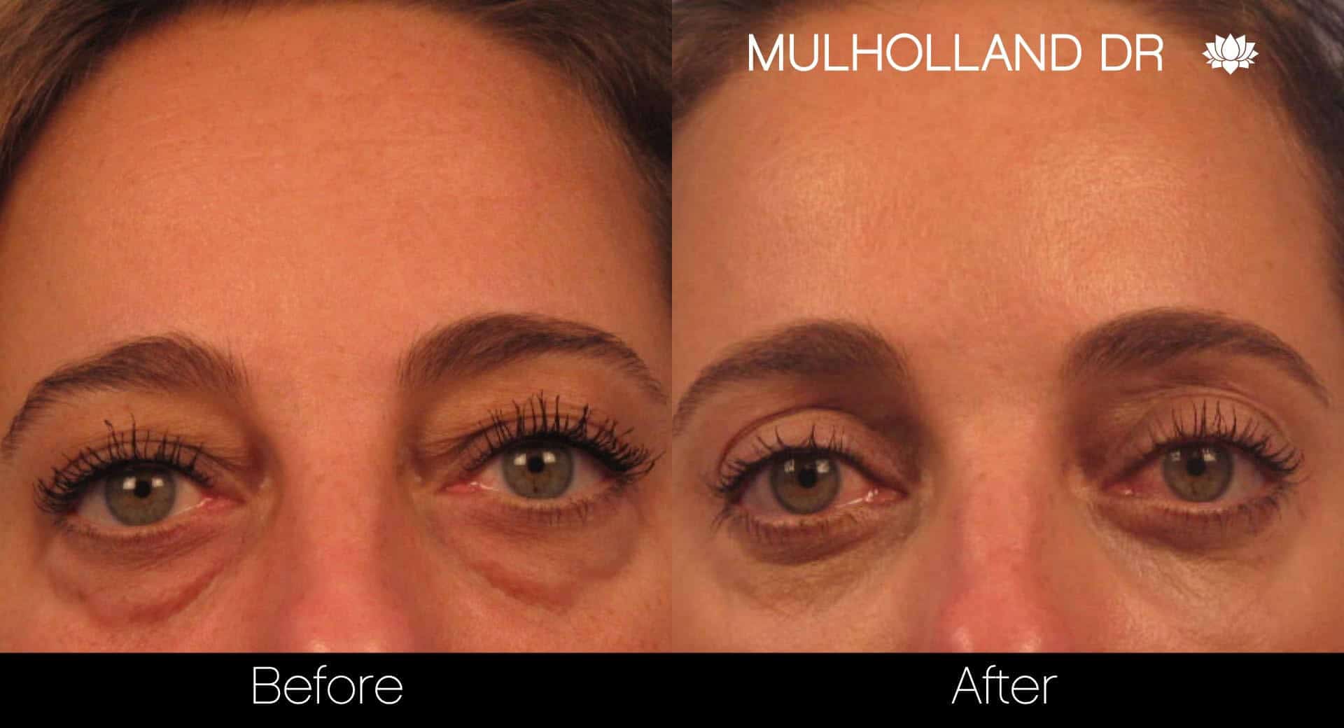 Blepharoplasty - Before and After Gallery – Photo 1