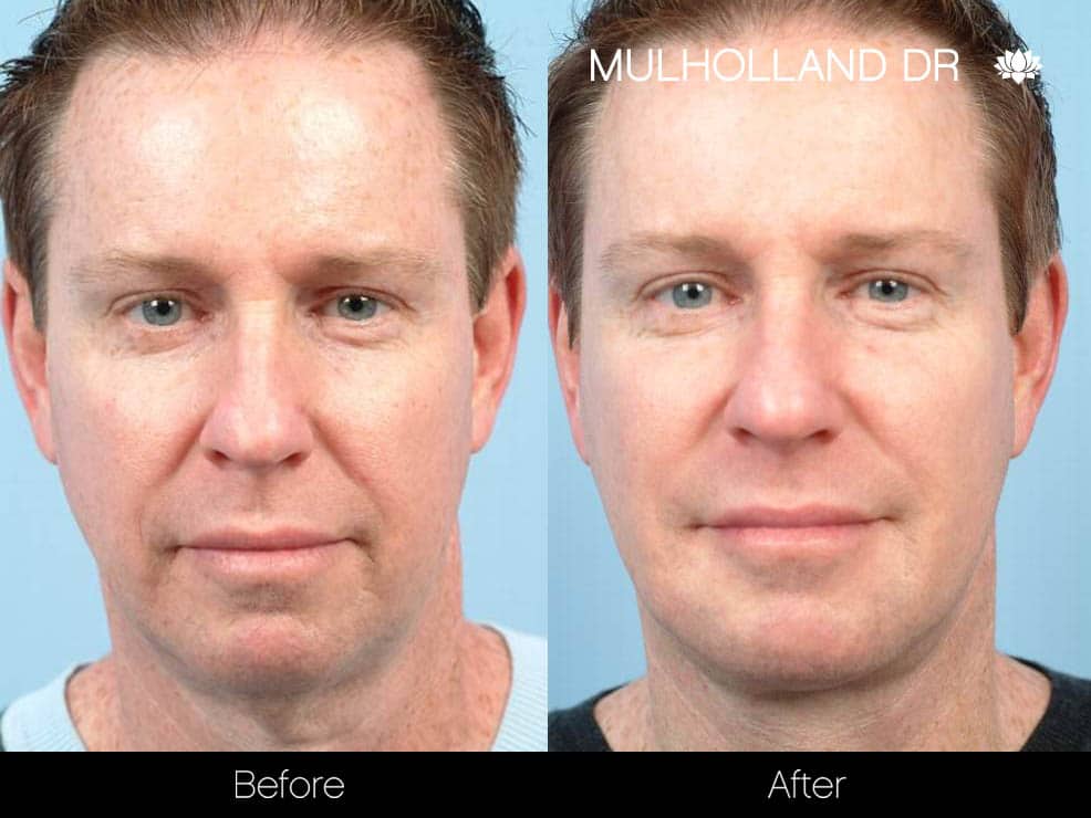 Male Neck Lift - Before and After Gallery – Photo 1