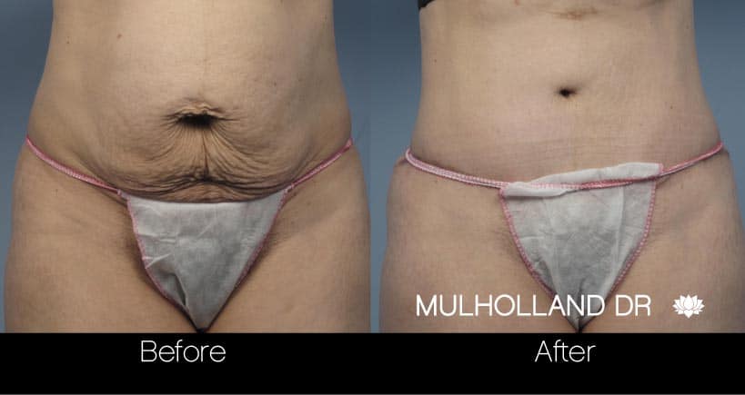 Mini Tummy Tuck in Toronto - Before and After