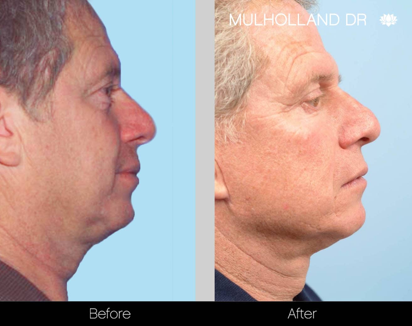 Male Double Chin - Before and After Gallery – Photo 23