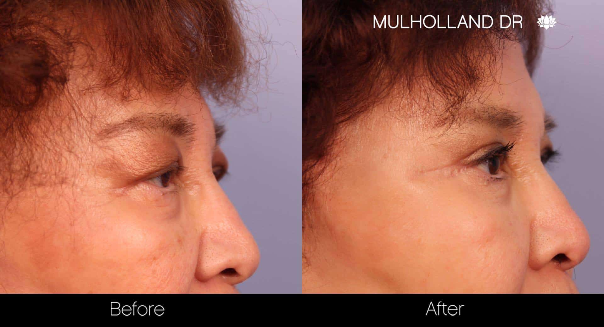 Blepharoplasty - Before and After Gallery – Photo 24