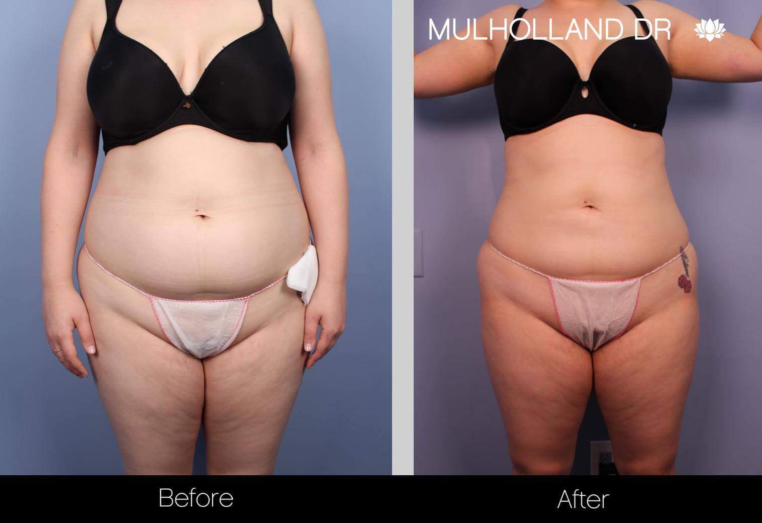 BodyTite Liposuction - Before and After Gallery - Patient Photo 25