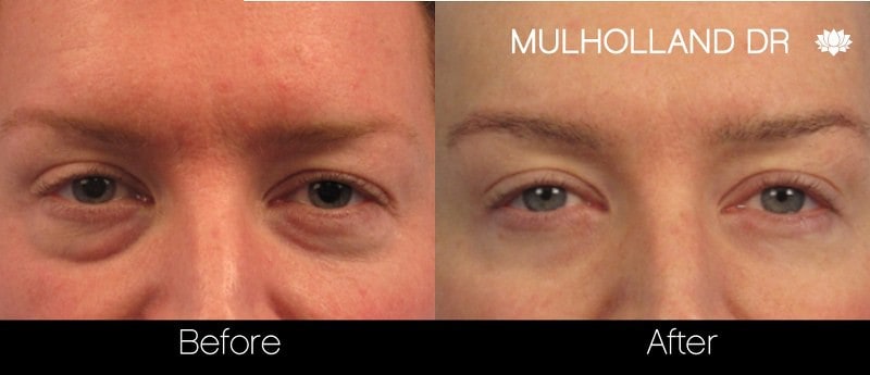 Blepharoplasty - Before and After Gallery – Photo 29