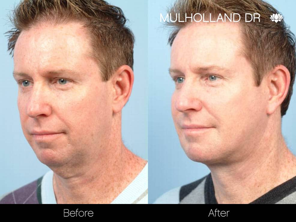 Male Neck Lift - Before and After Gallery – Photo 2