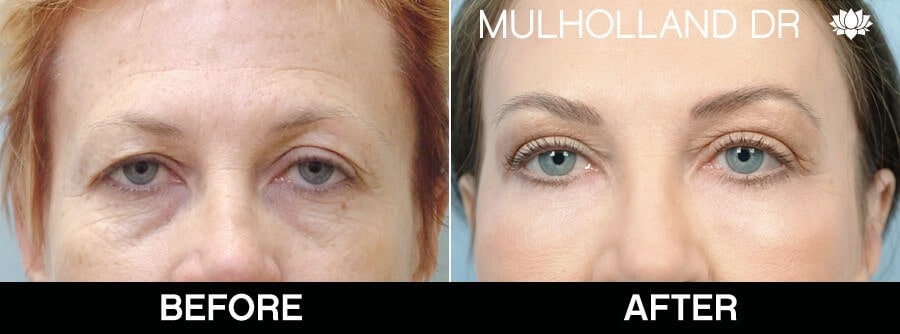 Blepharoplasty - Before and After Gallery – Photo 30