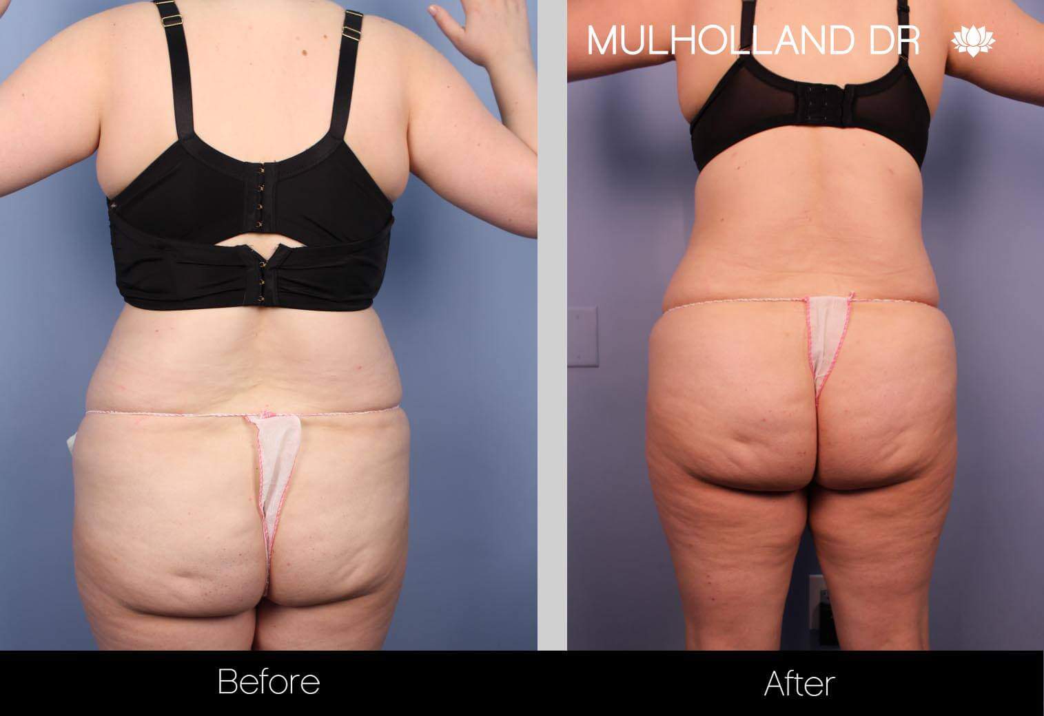 Body Lift - Before and After Gallery – Photo 33