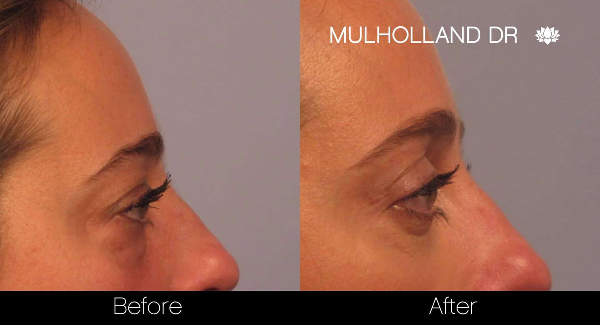 Blepharoplasty - Before and After Gallery – Photo 4