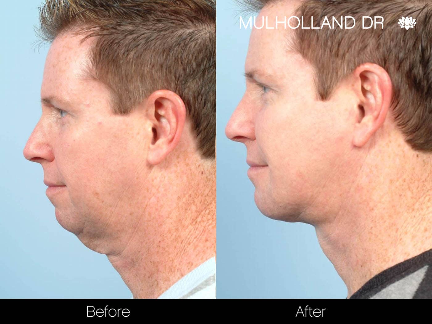Male Neck Lift - Before and After Gallery – Photo 4