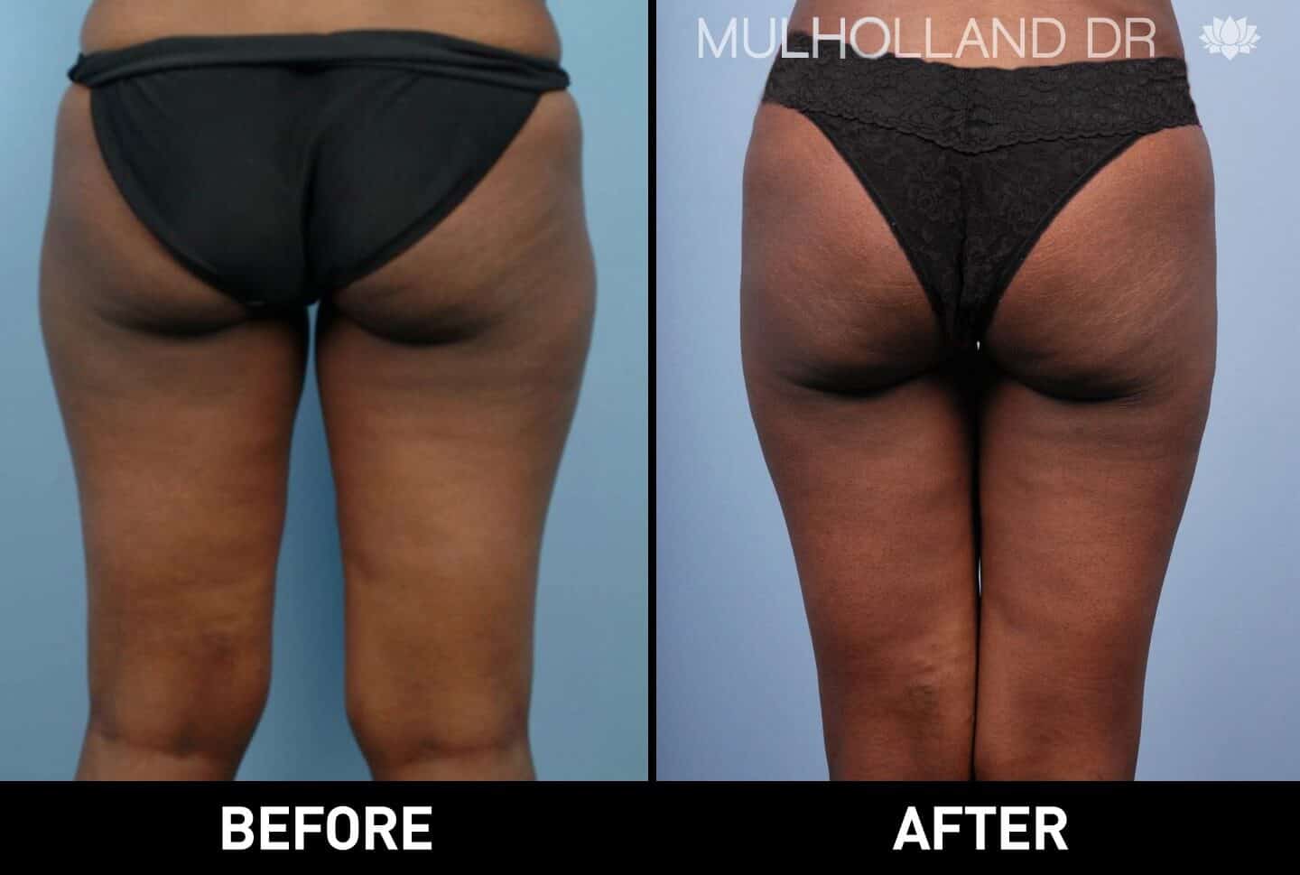 Liposuction -Before and After Gallery - Patient Photo 52