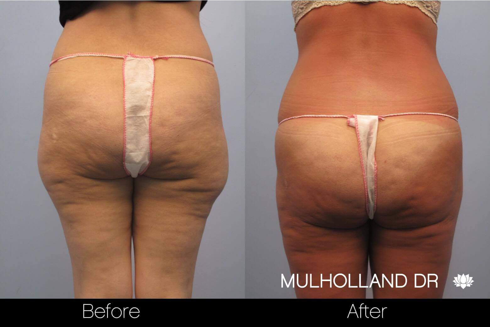BodyTite Liposuction - Before and After Gallery - Patient Photo 52