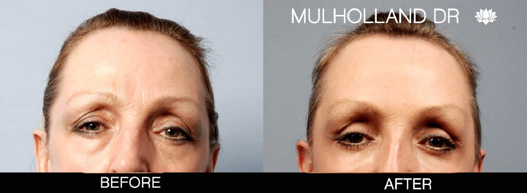 Blepharoplasty - Before and After Gallery – Photo 6
