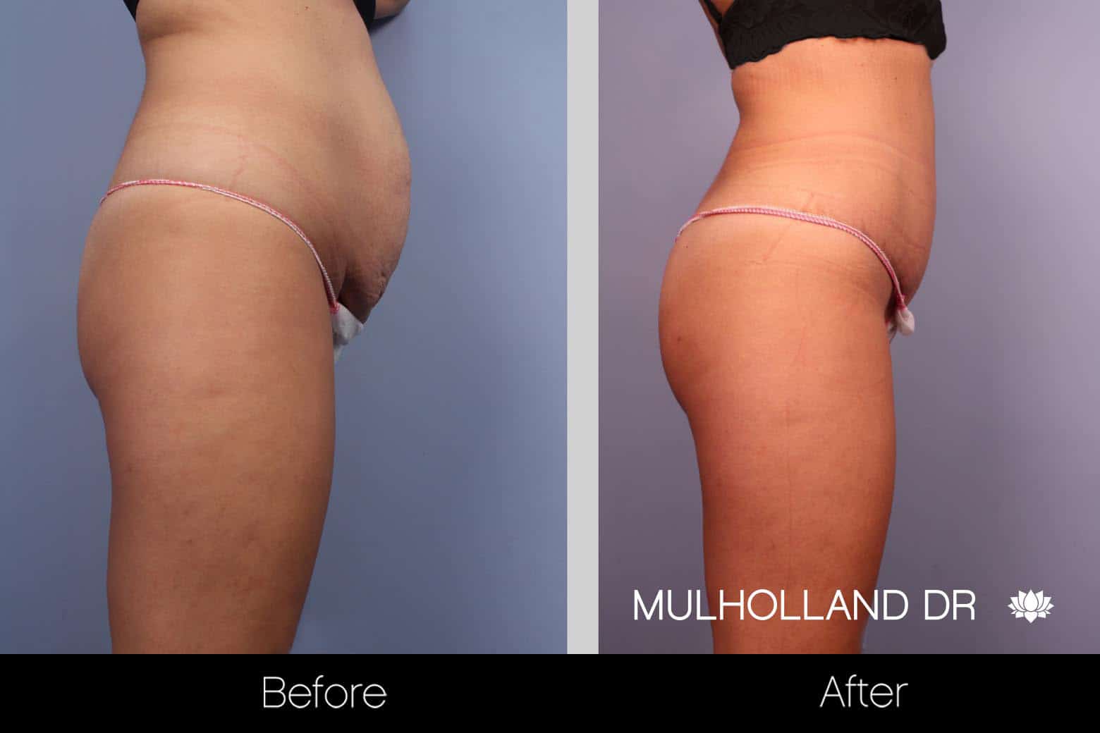 Before and After photos of Mini Tummy Tuck in Toronto Plastic Surgeons Clinic.