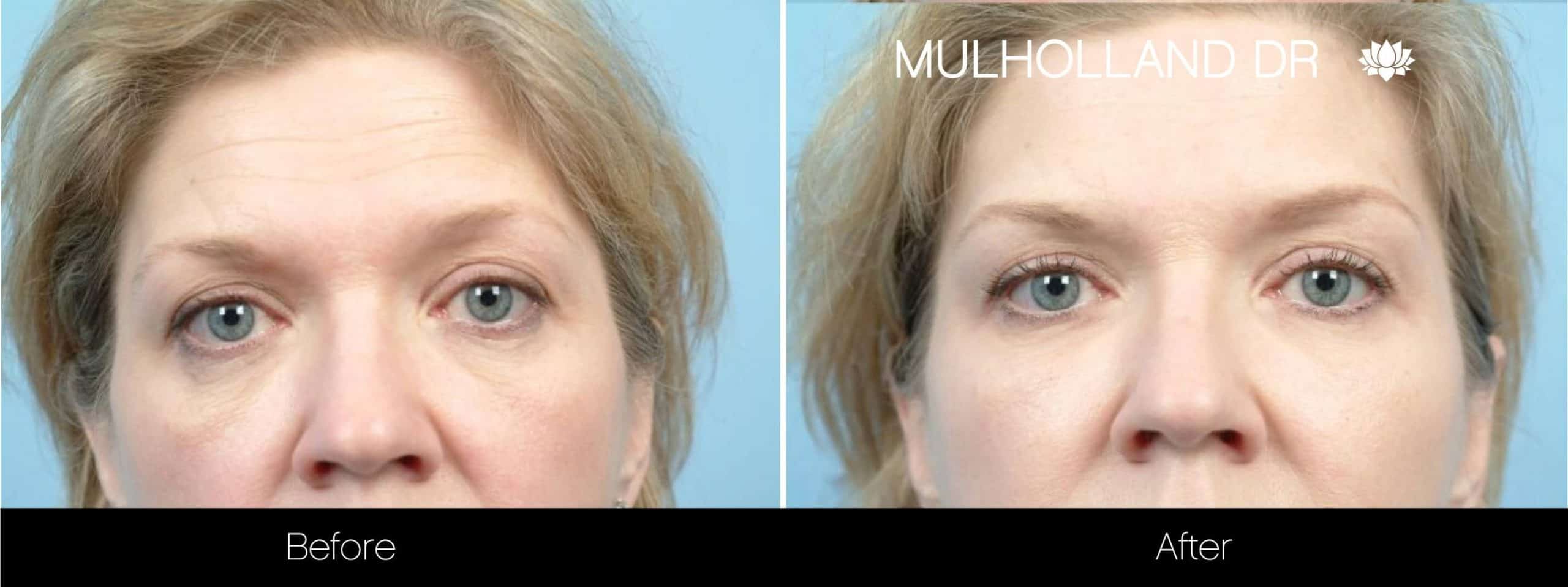 Fractional CO2 - Before and After Gallery - Patient Photo 71