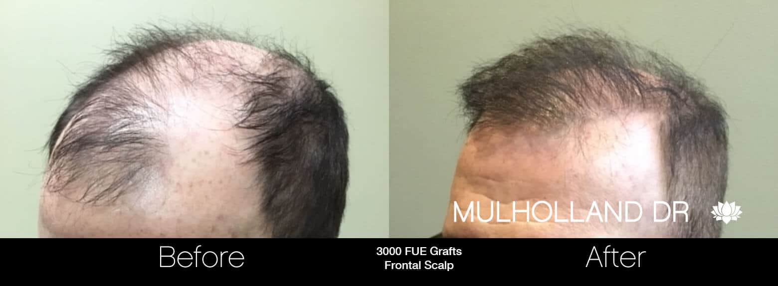 Artas Hair Transplant - Before and After Gallery - Patient Photo 82