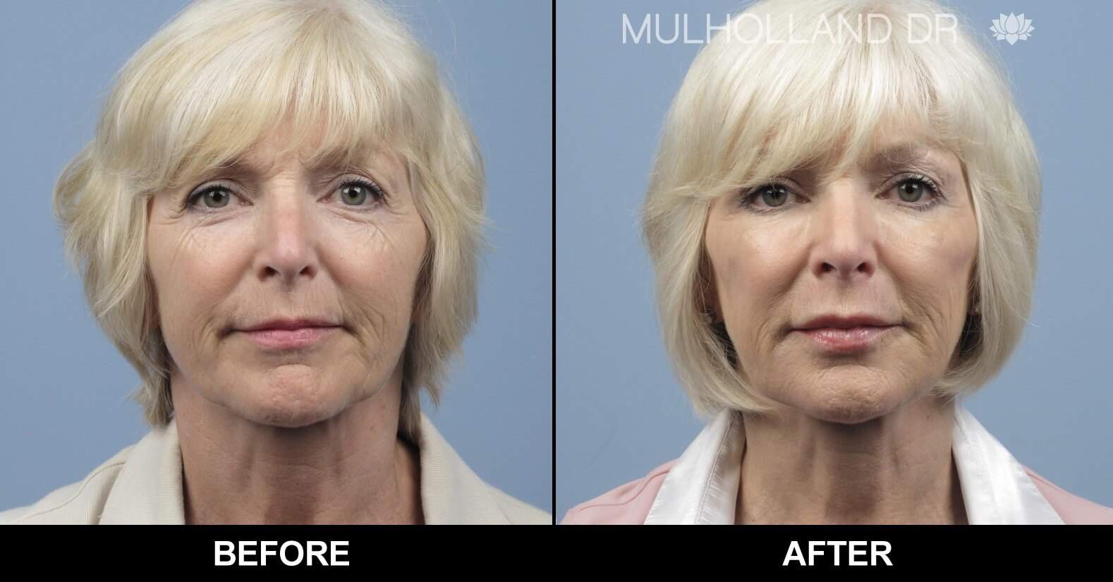 Fractional CO2 - Before and After Gallery - Patient Photo 8