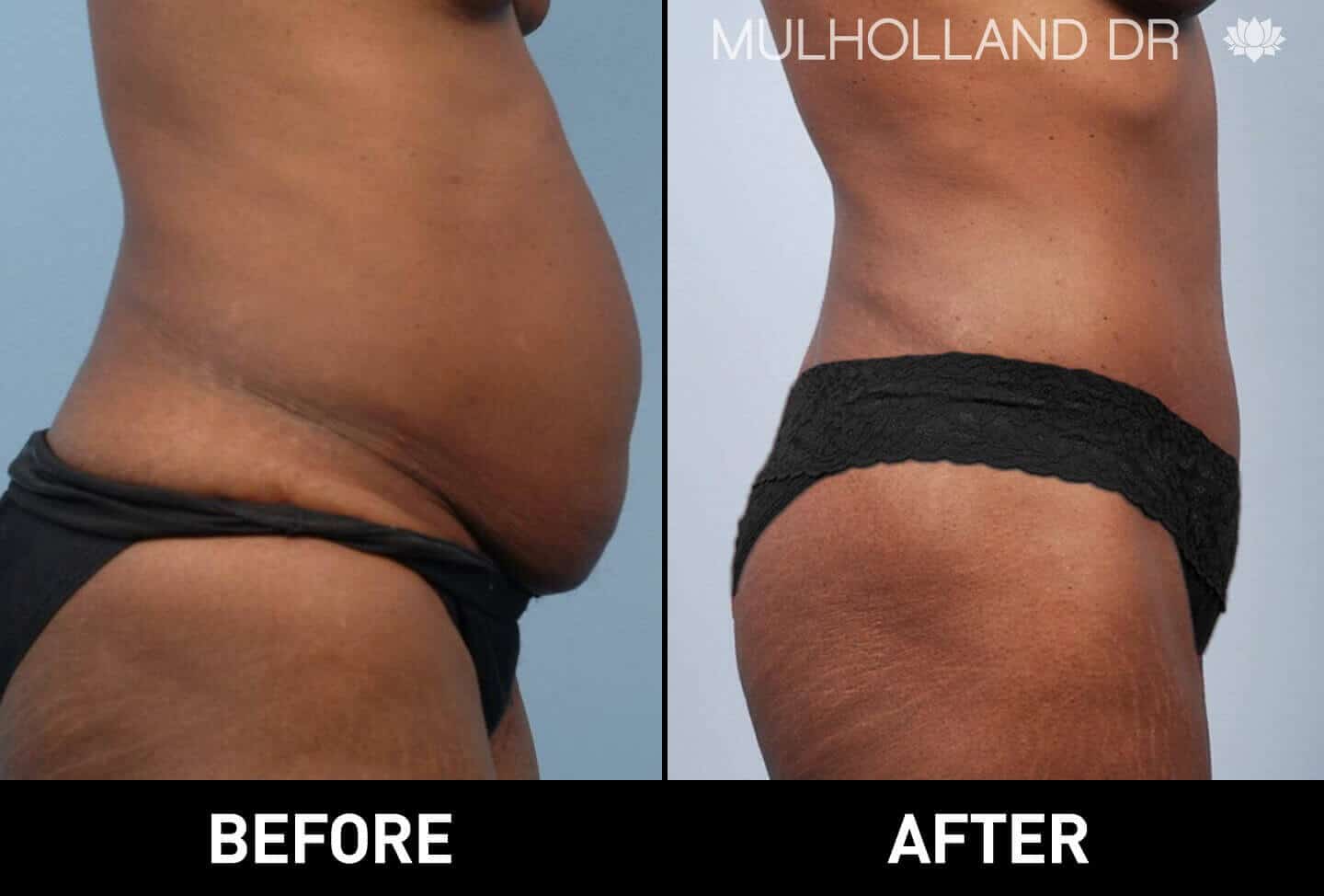 BodyTite Liposuction - Before and After Gallery - Patient Photo 8