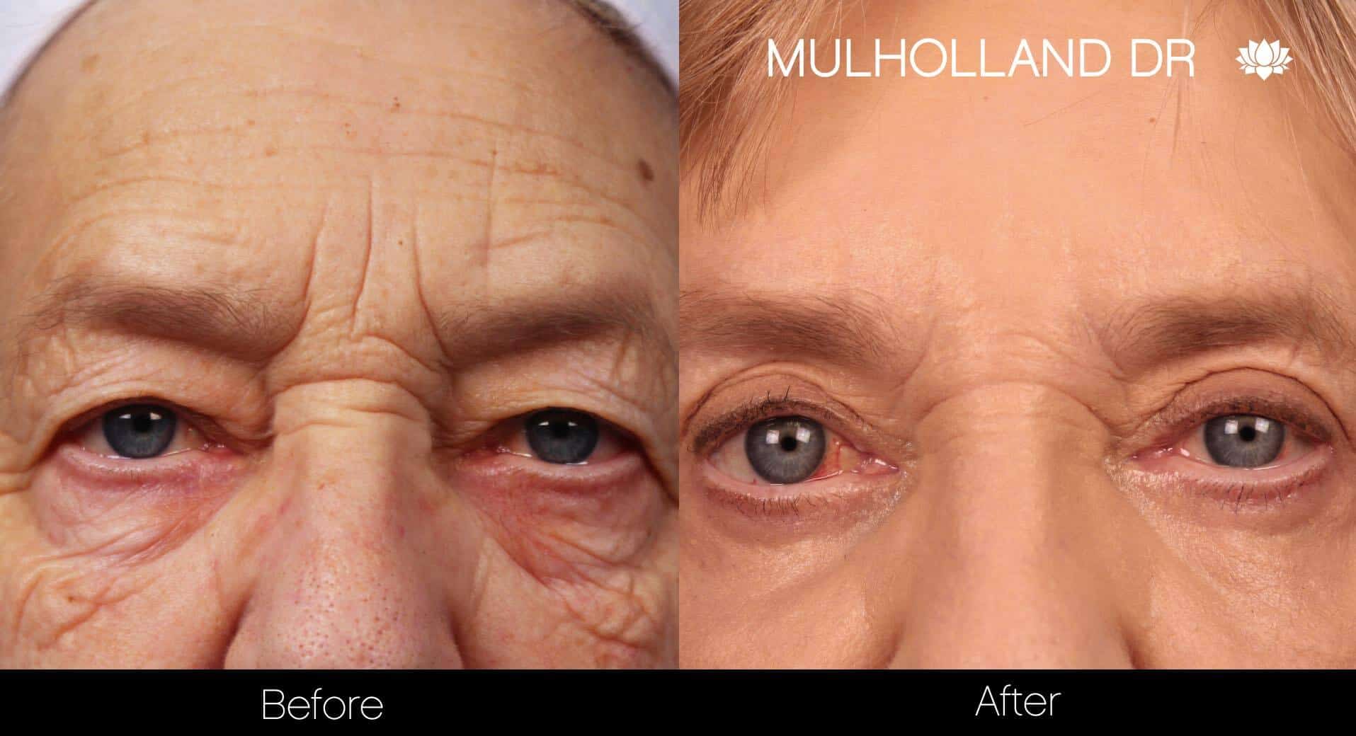 Blepharoplasty - Before and After Gallery – Photo 9