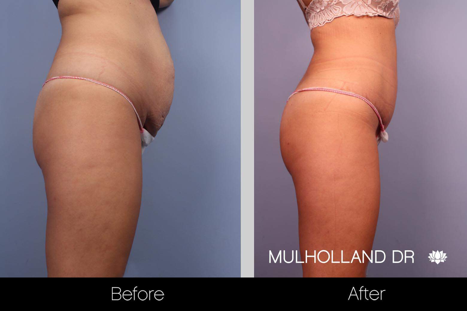 Liposuction -Before and After Gallery - Patient Photo 11