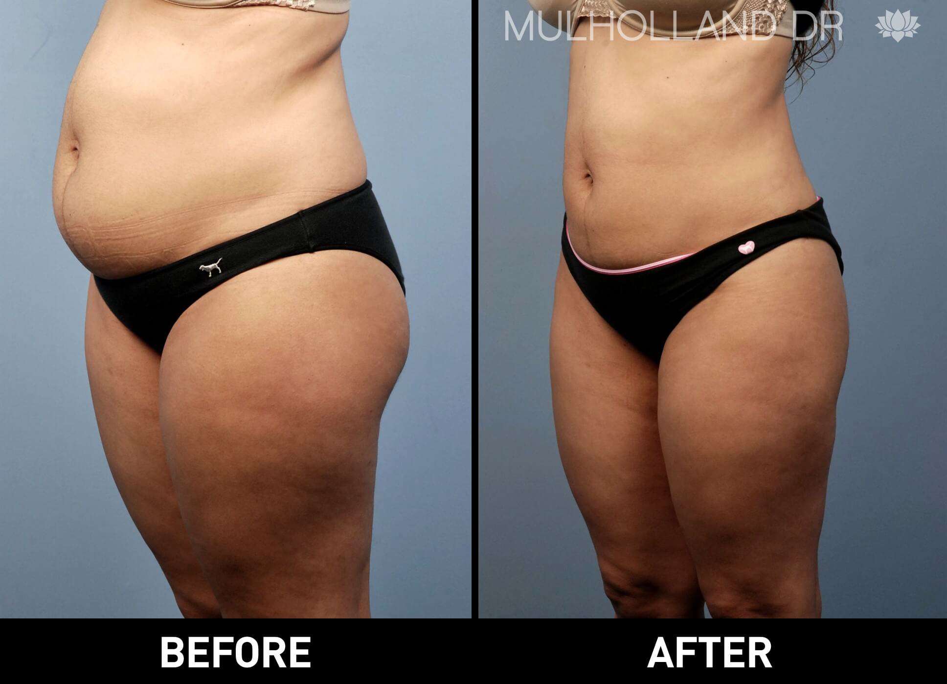 Liposuction -Before and After Gallery - Patient Photo 14