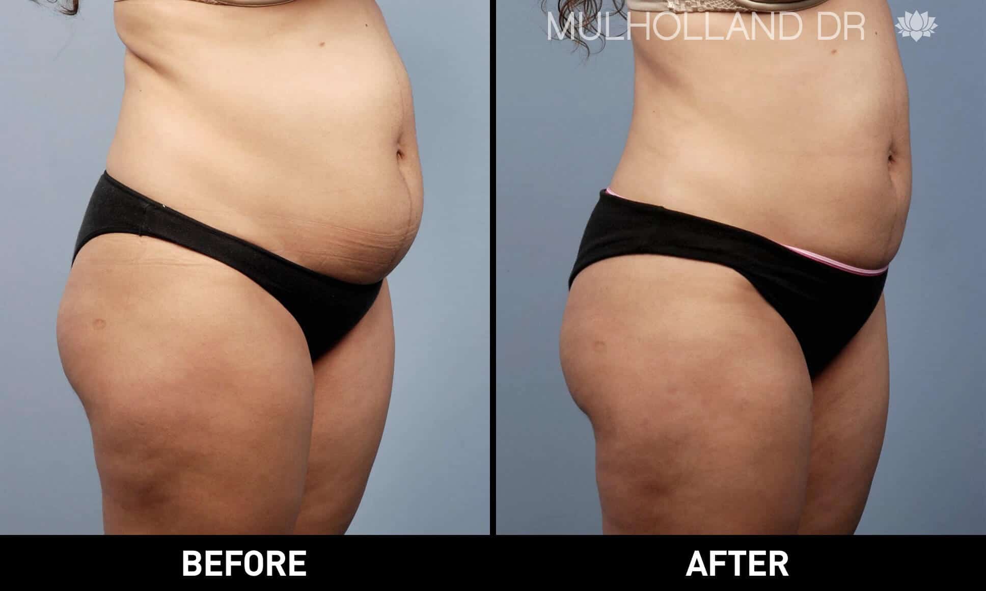 Liposuction -Before and After Gallery - Patient Photo 15