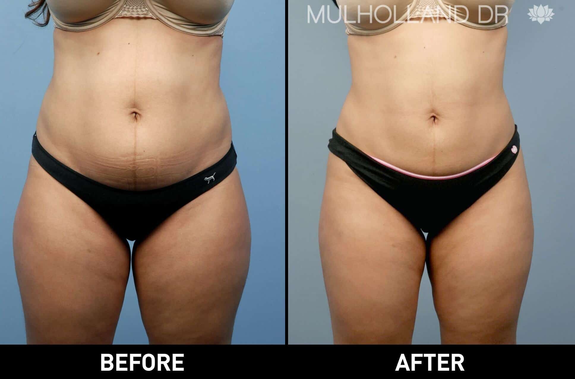 Liposuction -Before and After Gallery - Patient Photo 17