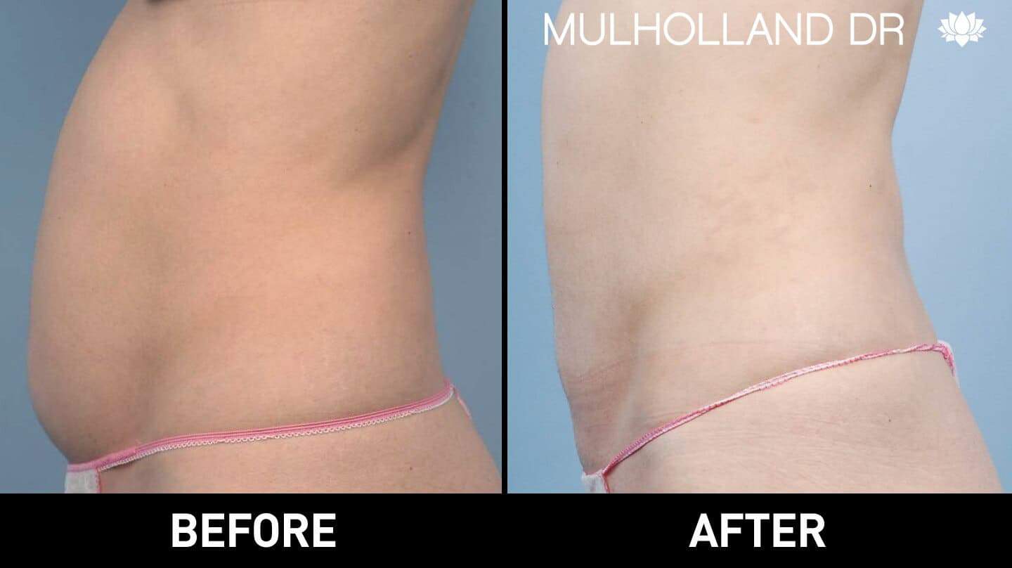 Liposuction -Before and After Gallery - Patient Photo 24
