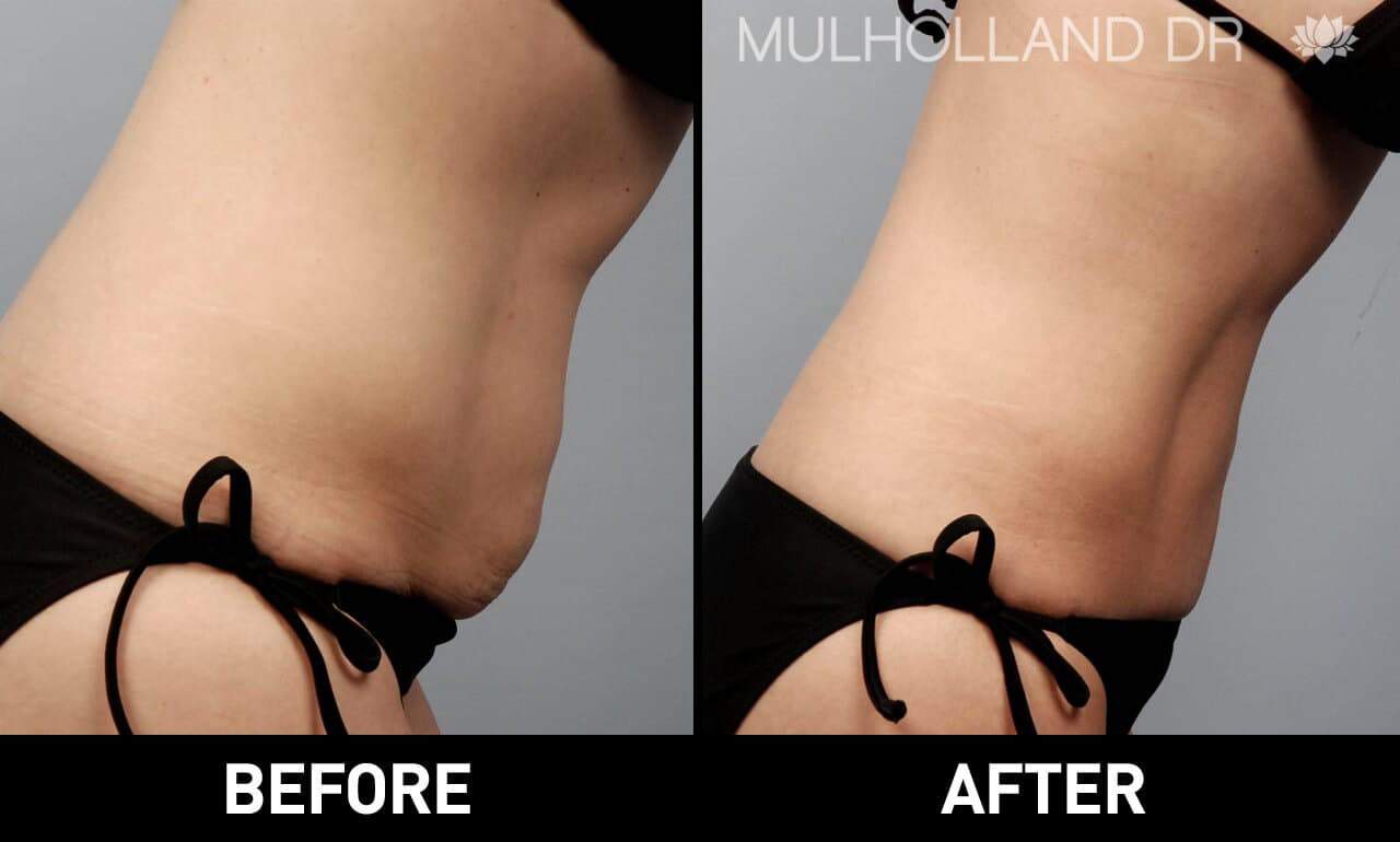 Liposuction -Before and After Gallery - Patient Photo 3