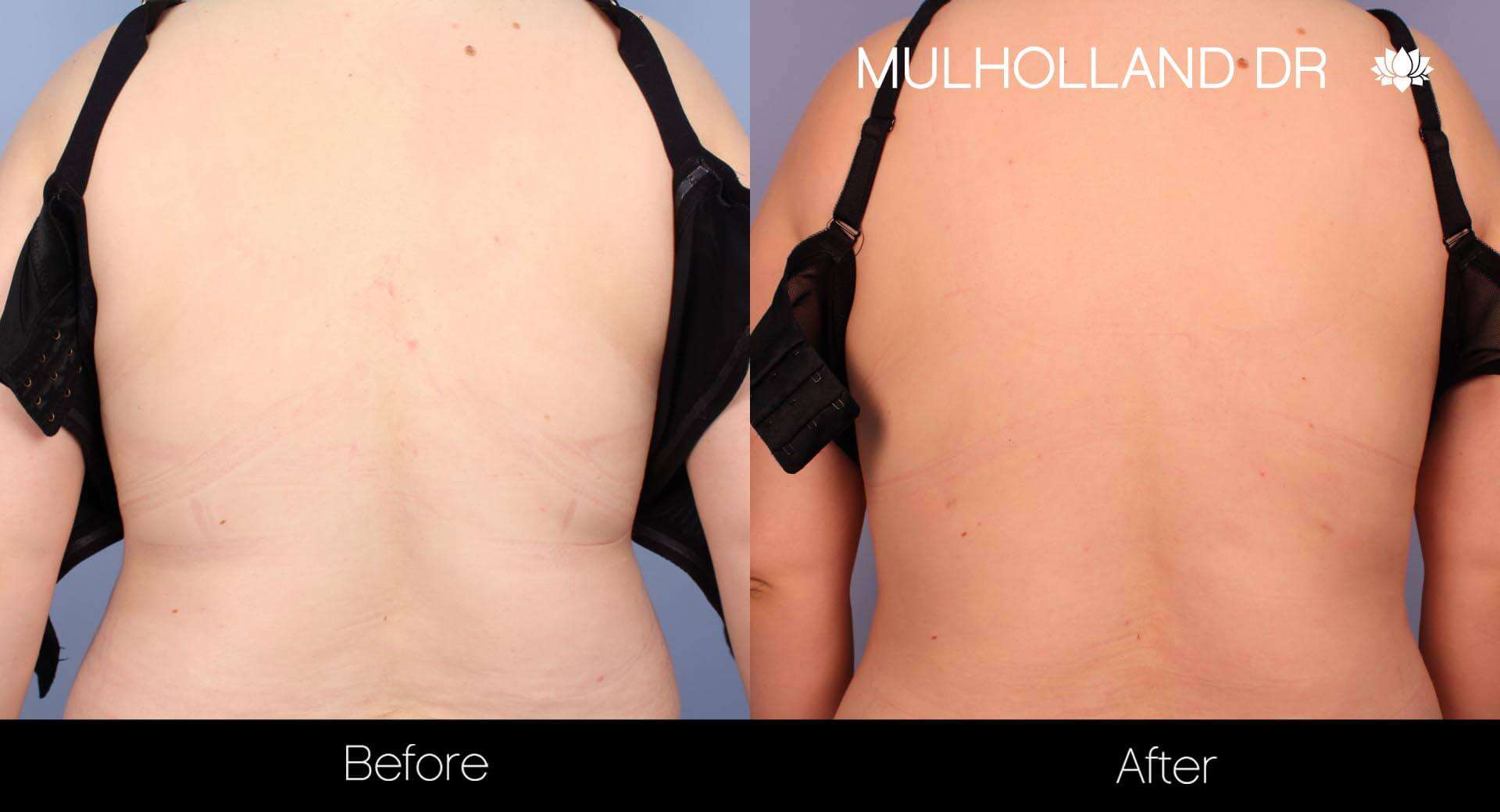 Liposuction -Before and After Gallery - Patient Photo 34