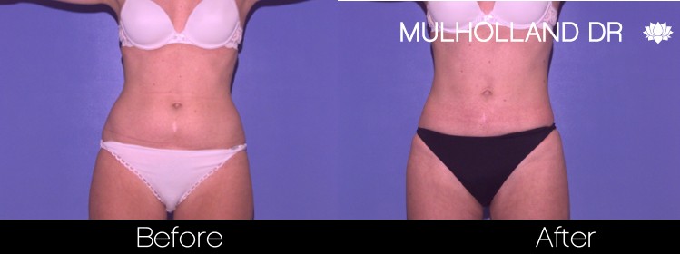 Liposuction -Before and After Gallery - Patient Photo 36