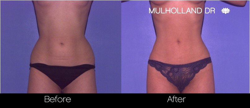 Liposuction -Before and After Gallery - Patient Photo 39