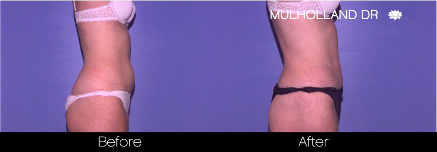 Liposuction -Before and After Gallery - Patient Photo 41