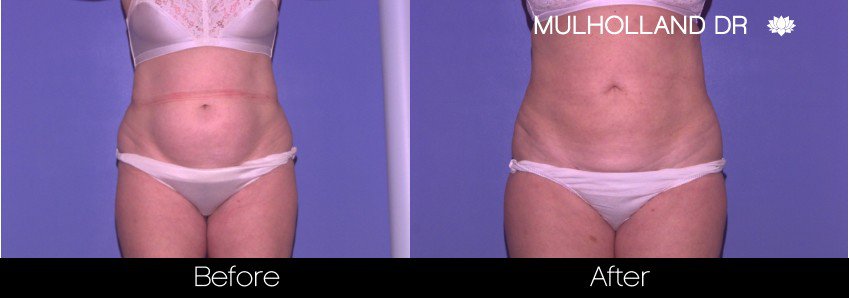 Liposuction -Before and After Gallery - Patient Photo 43