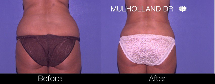 Liposuction -Before and After Gallery - Patient Photo 47