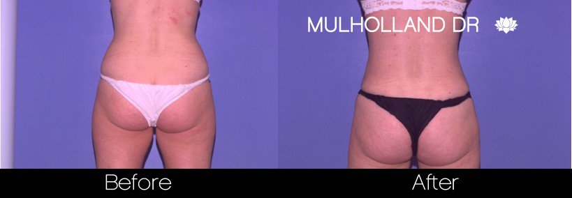 Liposuction -Before and After Gallery - Patient Photo 48