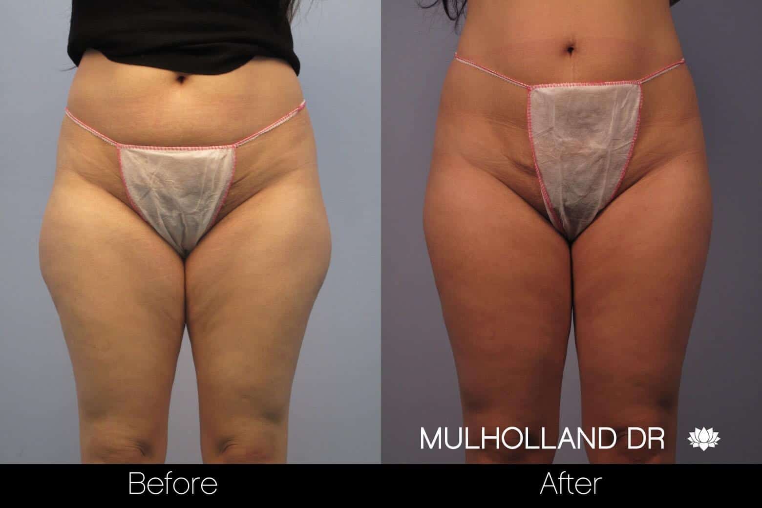 Liposuction -Before and After Gallery - Patient Photo 53