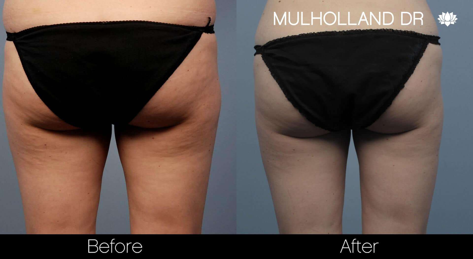 Liposuction -Before and After Gallery - Patient Photo 55
