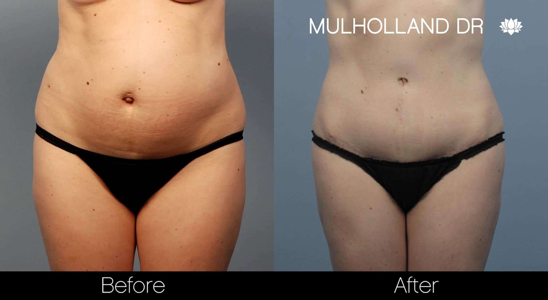 Liposuction -Before and After Gallery - Patient Photo 56