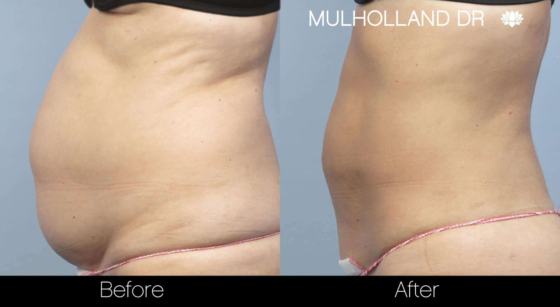 Liposuction -Before and After Gallery - Patient Photo 6