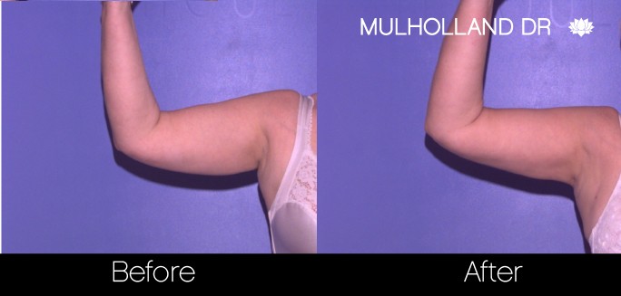 Liposuction -Before and After Gallery - Patient Photo 69