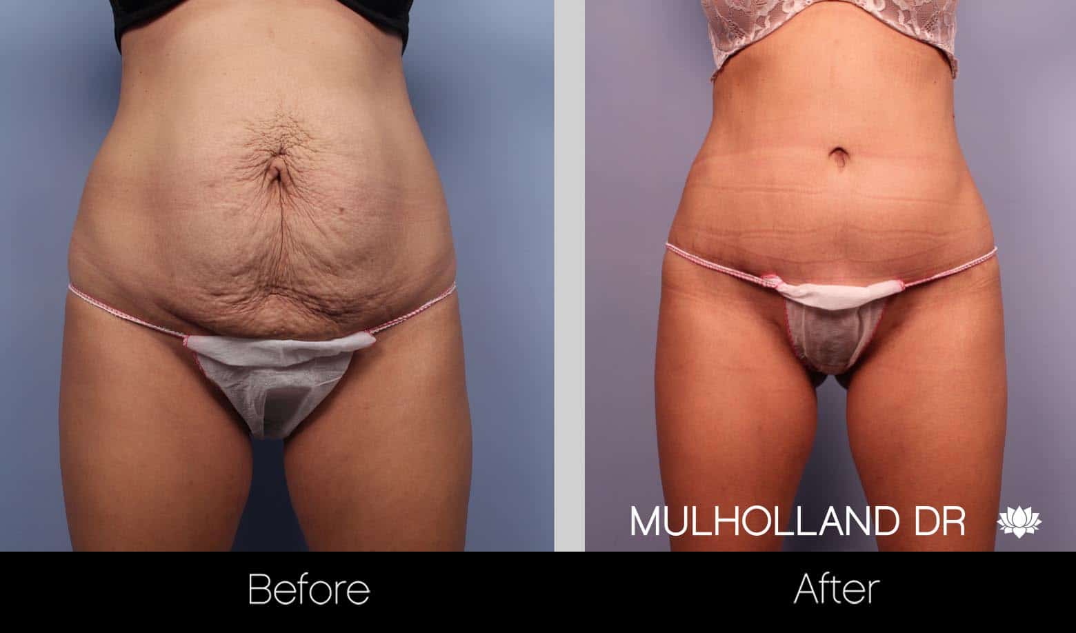 Liposuction -Before and After Gallery - Patient Photo 7