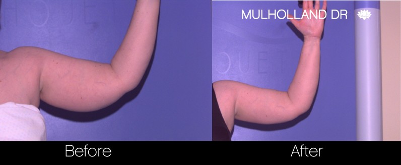 Liposuction -Before and After Gallery - Patient Photo 73