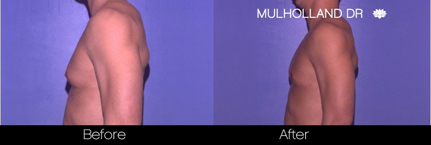 Liposuction -Before and After Gallery - Patient Photo 76