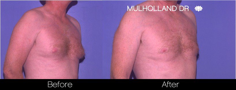 Liposuction -Before and After Gallery - Patient Photo 77