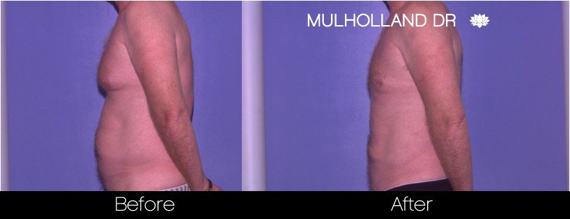 Liposuction -Before and After Gallery - Patient Photo 79